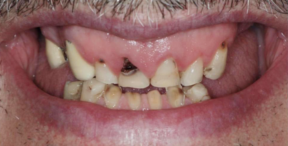denti prima operazione